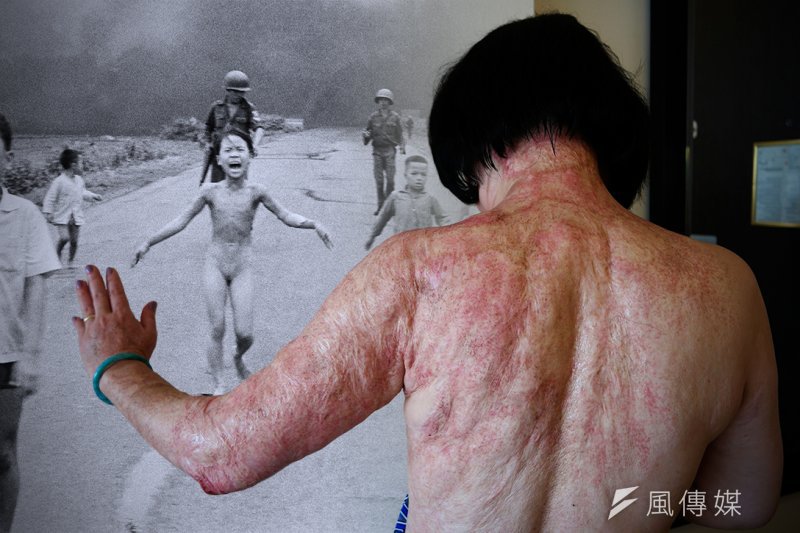 1972年在越戰中遭燃燒彈嚴重灼傷的9歲女孩潘金淑(Phan Thị Kim Phúc),43年來都在與生理及心理上的創傷搏鬥。(照片:美聯社,版面構成:風傳媒)