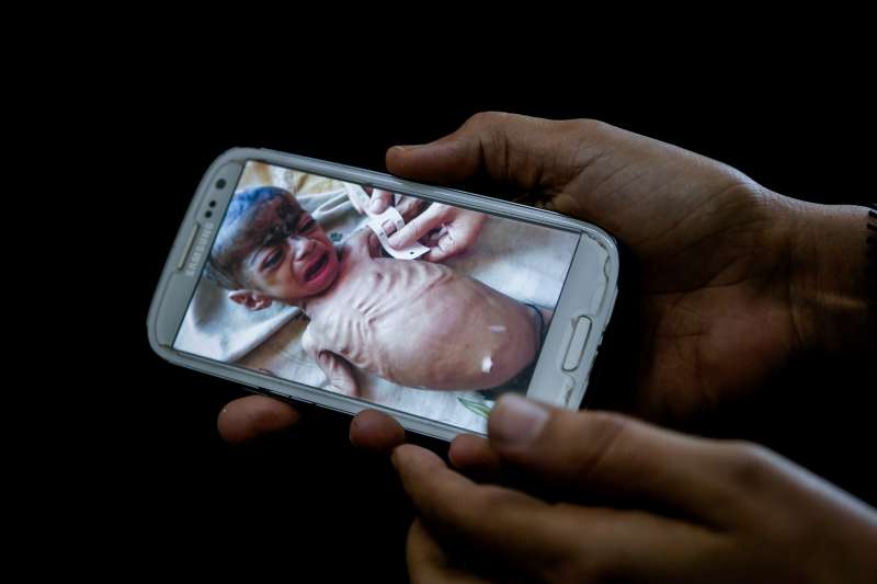 葉門嬰兒(AP) 葉門嬰兒(AP)