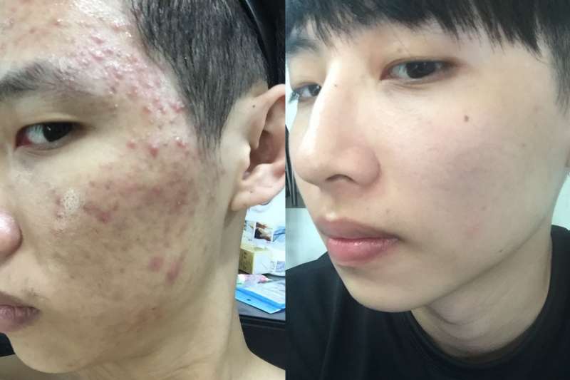 曾歷經八年「戰痘」經驗的Alan,秀出過往被痘瘡糾纏的慘狀照片。(圖/Alan提供)