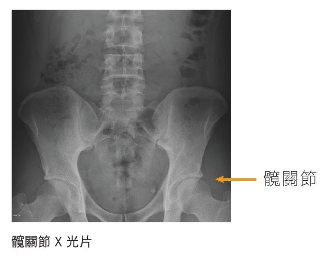 髖關節X光片(圖/三采文化提供) 髖關節X光片(圖/三采文化提供)