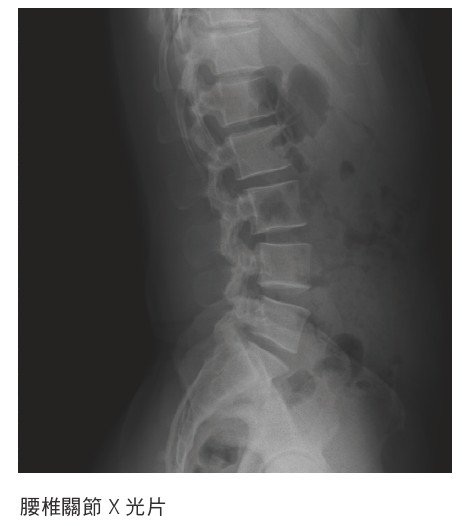 腰椎關節X光片(圖/三采文化提供)