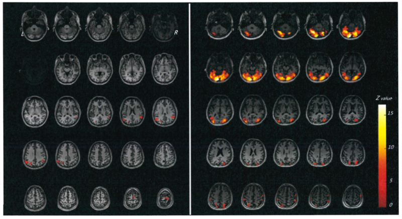 腦部活化分布圖，暗紅色到亮黃色代表腦部活動程度由低到高。圖左是陳員的視覺功能分布區，圖右是對照者的視覺功能分布區。（監察院提供）