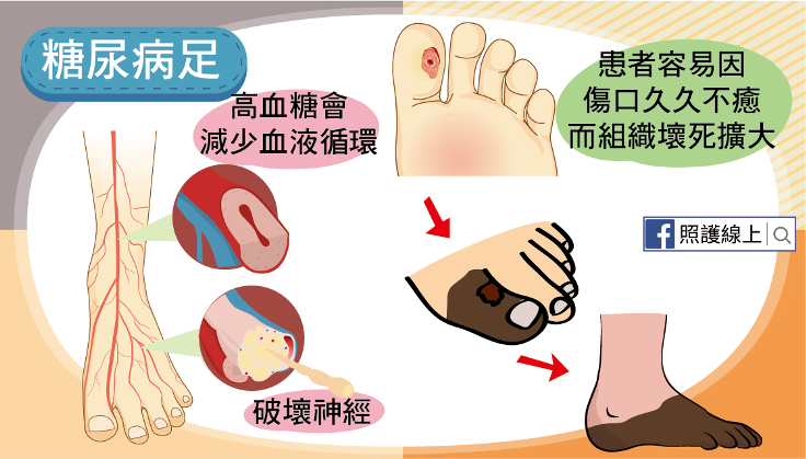 糖尿病併發症懶人包-05(圖/照護線上) 糖尿病併發症懶人包-05(圖/照護線上)