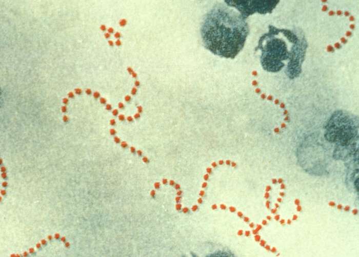 眾多產褥熱病例當中,以感染化膿性鏈球菌(Streptococcus pyogenes,紅色染色球菌)最為嚴重。(取自維基百科) 眾多產褥熱病例當中,以感染化膿性鏈球菌(Streptococcus pyogenes,紅色染色球菌)最為嚴重。(取自維基百科)
