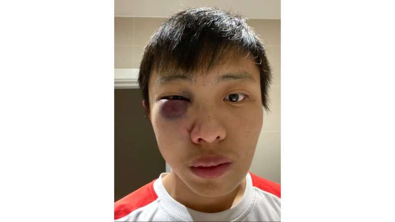 武漢肺炎全球蔓延,對亞裔族群的歧視事件不斷發生,新加坡留學生在英國倫敦街頭遭圍毆(取自Jonathan Mok臉書) 武漢肺炎全球蔓延,對亞裔族群的歧視事件不斷發生,新加坡留學生在英國倫敦街頭遭圍毆(取自Jonathan Mok臉書)