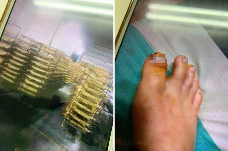 20200619-移工職災配圖(當事人提供) 20200619-移工職災配圖(當事人提供)