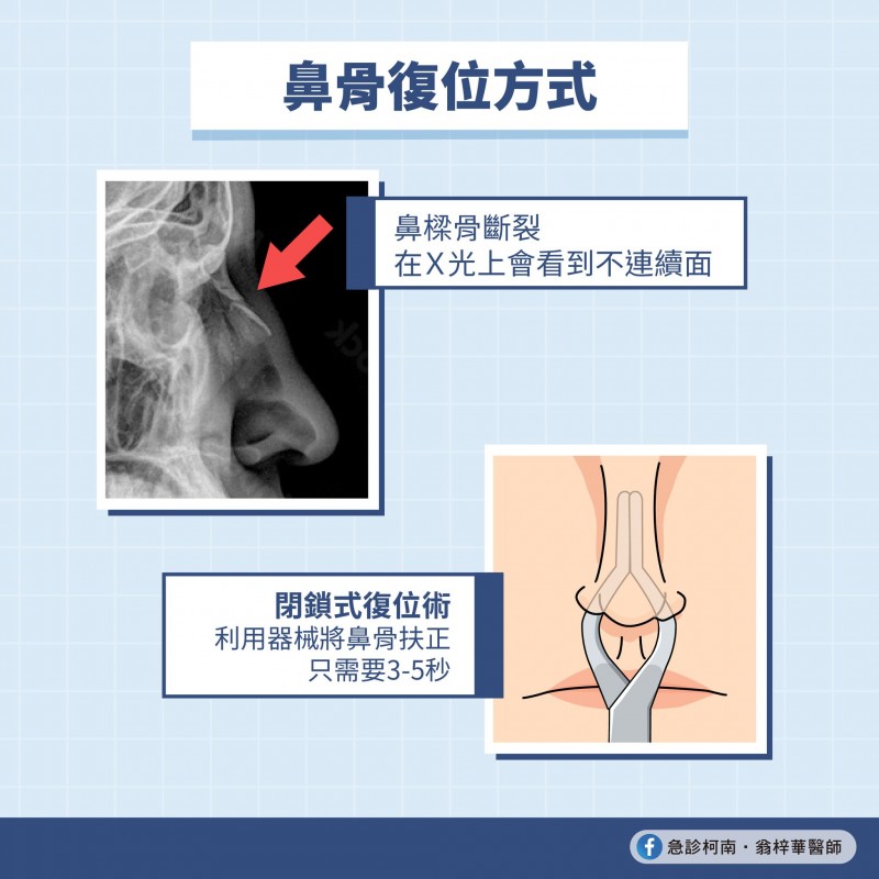 鼻骨復位法。(圖/《急診柯南.翁梓華醫師》授權使用,請勿翻攝) 鼻骨復位法。(圖/《急診柯南.翁梓華醫師》授權使用,請勿翻攝)