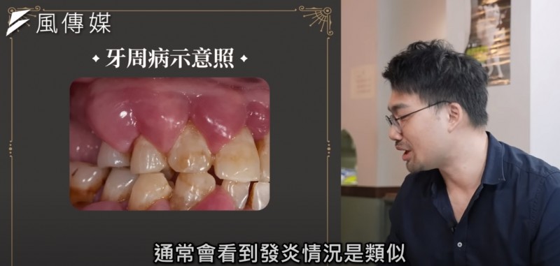 牙周病示意圖。(圖/取YouTube頻道《下班經濟學》) 牙周病示意圖。(圖/取YouTube頻道《下班經濟學》)