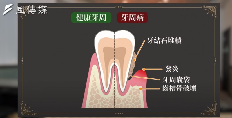 健康牙齒與牙周病比較。(圖/取YouTube頻道《下班經濟學》) 健康牙齒與牙周病比較。(圖/取YouTube頻道《下班經濟學》)